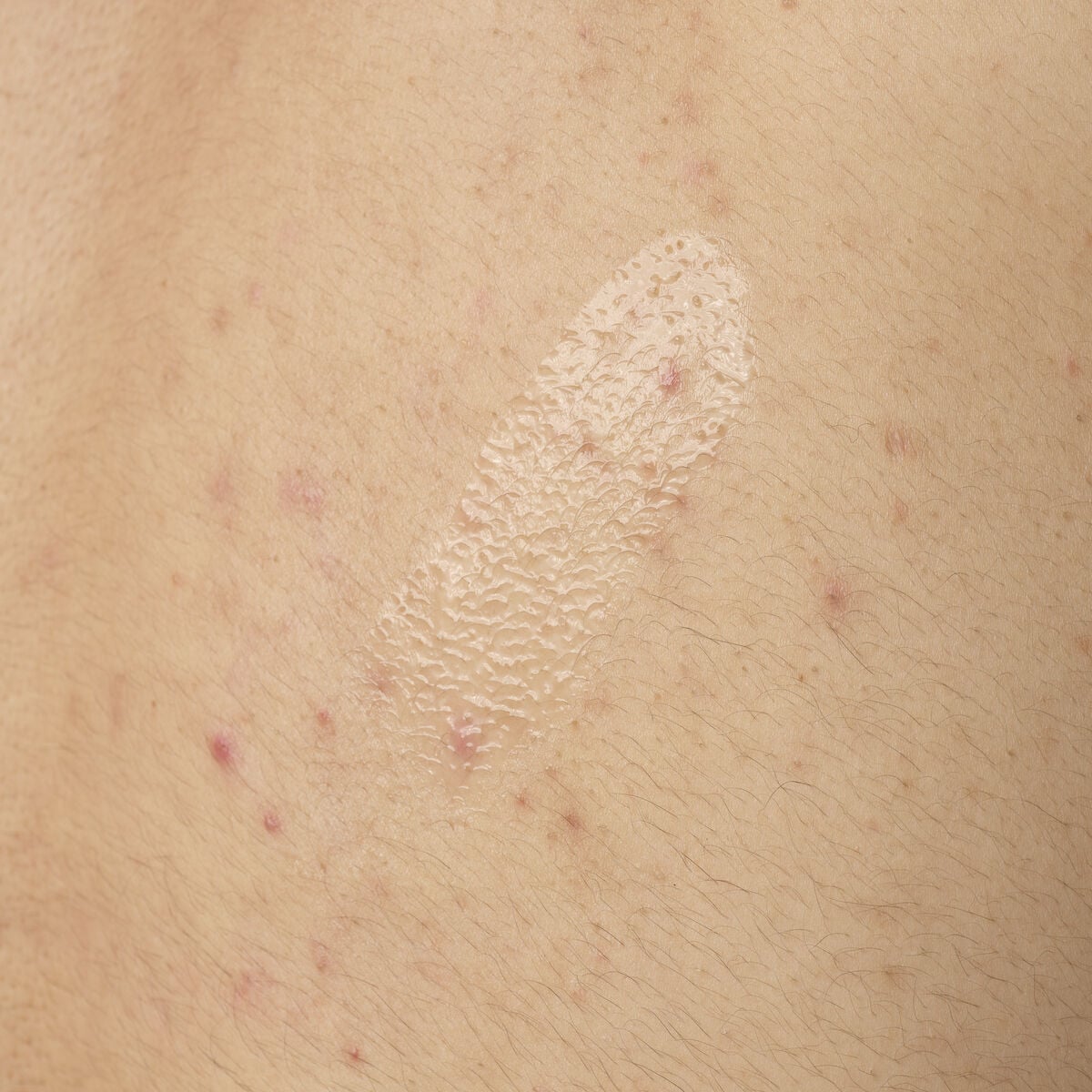 salicylic-acid-0-5-body-serum-z1 ORD-salicylic-acid-05-body-240ml-application.jpg