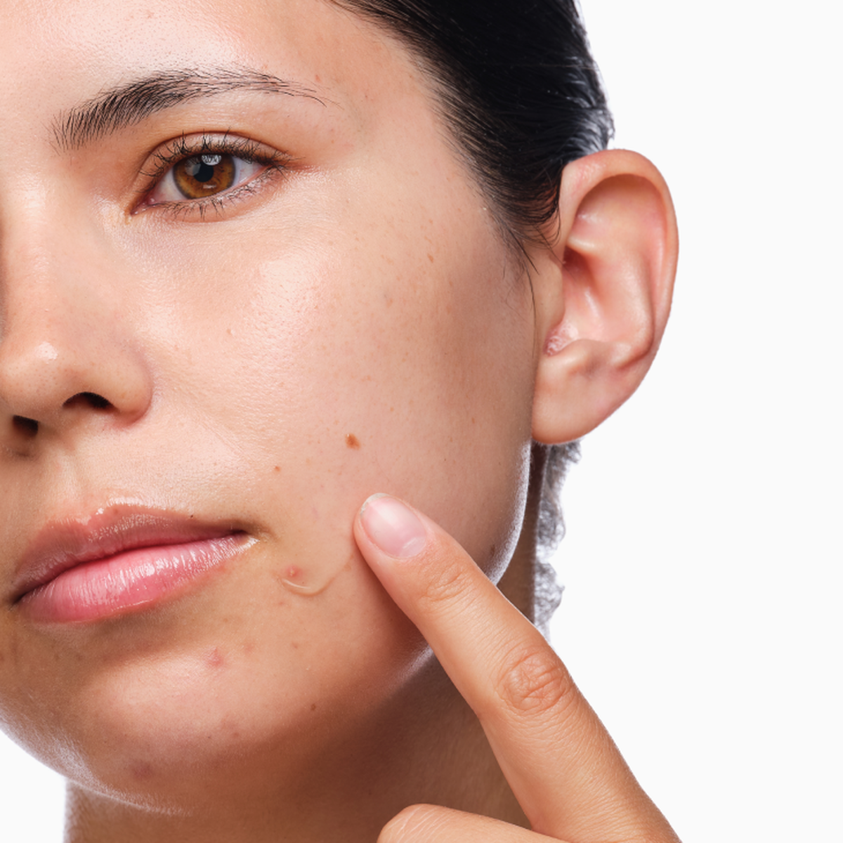 the-acne-set-e3 rdn-the-acne-set-application.png