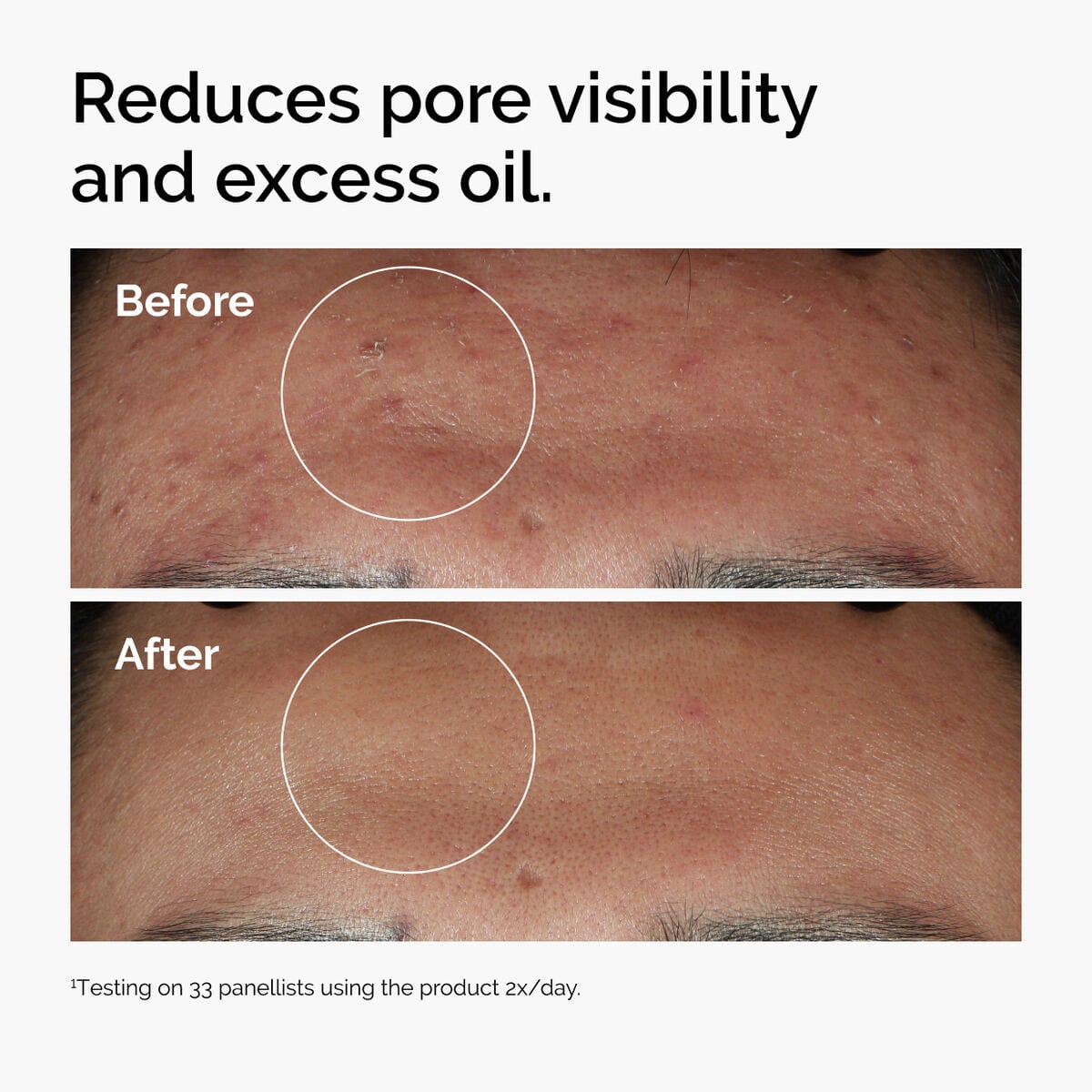niacinamide-10-zinc-1-w5 ord-niacinamide-zinc-blemish-serum-before-after-pores.jpg
