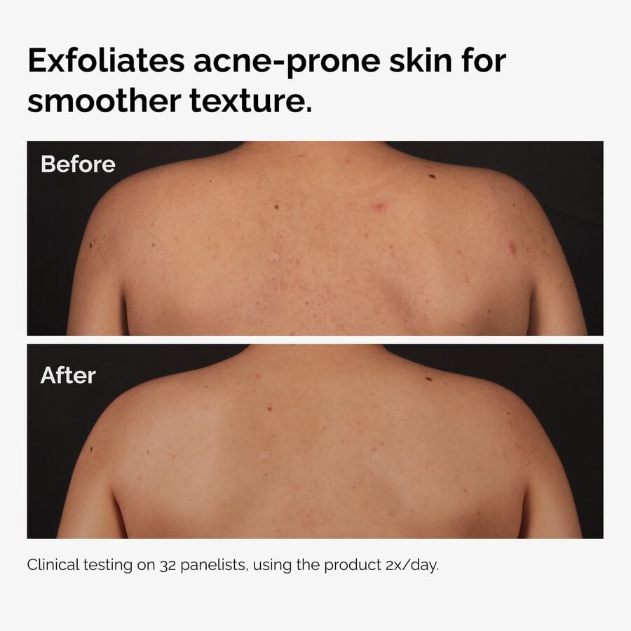 the-body-care-collection-x1 ord-salicylic-acid-body-serum-before-after-graphic-NA.jpg