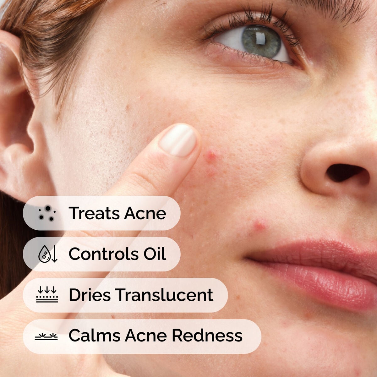 sulfur-10-powder-to-cream-concentrate-s9 ord-sulfur-10pct-powder-to-cream-concentrate-model-application-with-benefits-acne.jpg